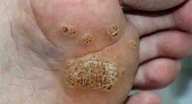 6 Types of Warts: Signs, Symptoms, Home Remedies, and Effective Treatments You Should Know