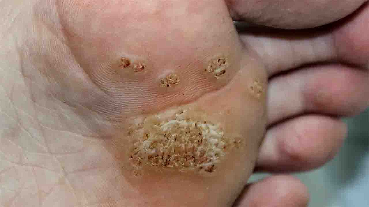 6 Types of Warts: Signs, Symptoms, Home Remedies, and Effective Treatments You Should Know
