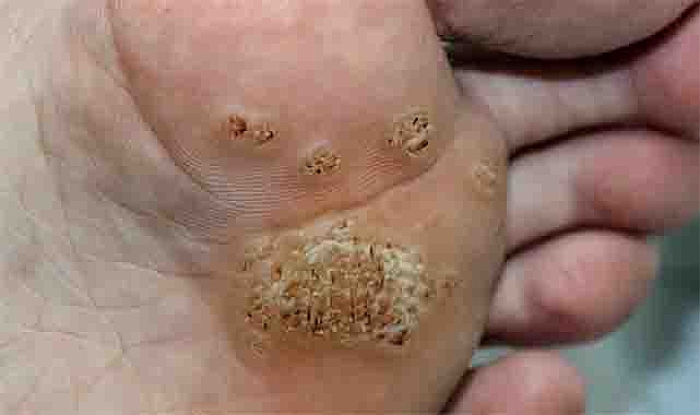 6 Types of Warts: Signs, Symptoms, Home Remedies, and Effective Treatments You Should Know