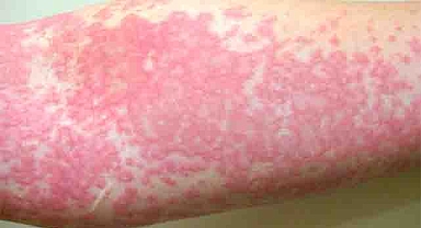 The Fiery Rash That Turned Out to Be a Rare Immune Disorder: Understanding Sweet Syndrome