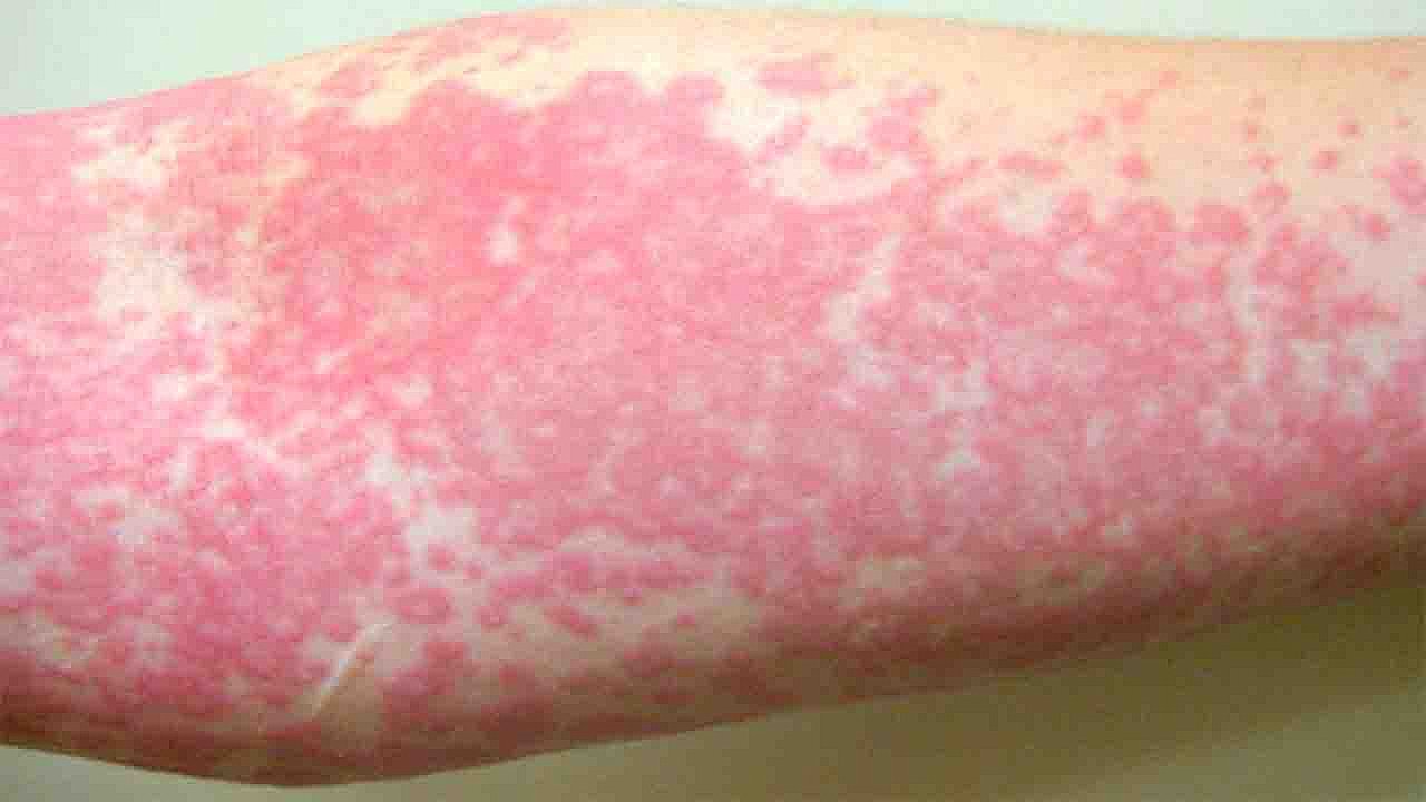 The Fiery Rash That Turned Out to Be a Rare Immune Disorder: Understanding Sweet Syndrome